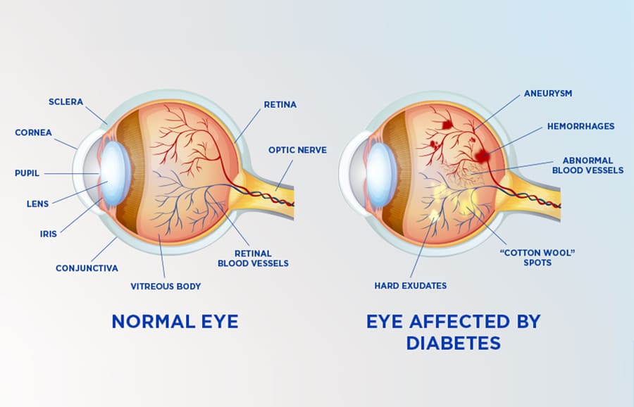Diabetic Eye Exam in Brooklyn